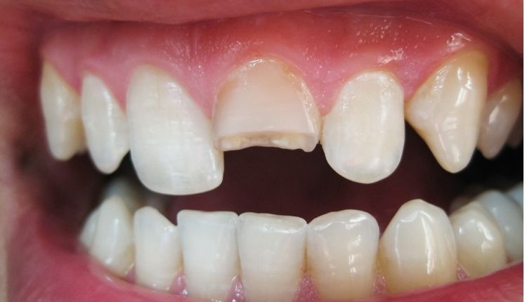 Kırık Diş Nasıl tedavi Edilir