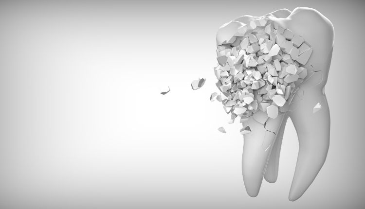 Kırık Diş Tedavisi Hakkında Sık Sorulan Sorular Nelerdir
