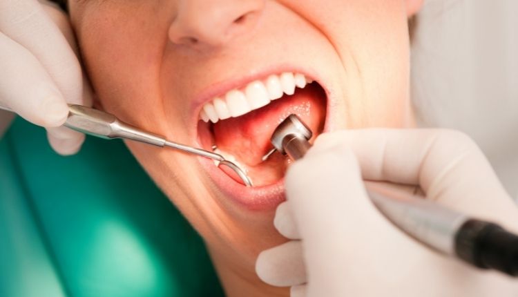 Diş Taşı Nasıl Temizlenir Hakkında Detaylar