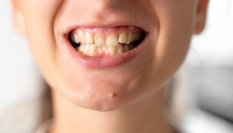 Diş Taşı Nedir Nasıl Anlaşılır