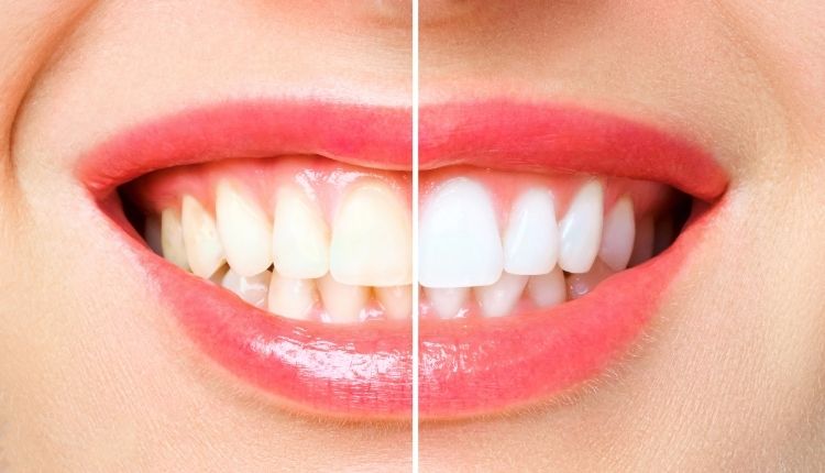 Ofs Tipi Diş Beyazlatma Nasıl Yapılır