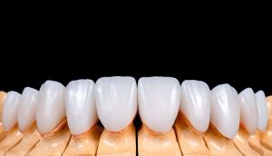 Porselen Diş Kaplama Nedir